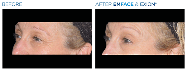 Emface_Exion_PIC_Ba-card-eyes-female-002_FRF_Face_ENUS100