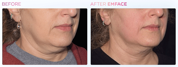 Emface_PIC_Ba-card-female-jawline-025_ENUS100