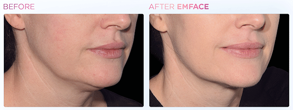 Emface_PIC_Ba-card-female-jawline-032_ENUS100