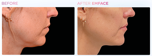 Emface_PIC_Ba-card-female-jawline-067_ENUS100