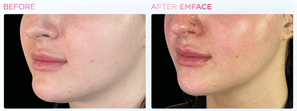 Emface_PIC_Ba-card-female-jawline-084_ENUS100