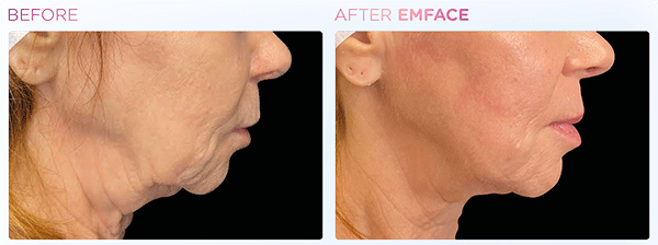 Emface_PIC_Ba-card-female-jawline-104_ENUS100