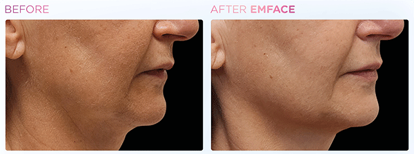 Emface_PIC_Ba-card-jawline-face-106_ENUS100