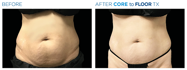 Emsculpt_Neo-Emsella_PIC_Ba-card-female-abdomen-007_ENUS100