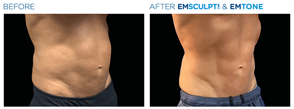 Emsculpt_Neo-Emtone_PIC_Ba-card-male-abdomen-014_ENUS100