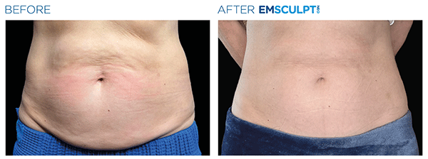 Emsculpt_Neo_PIC_Ba-card-female-abdomen-139_ENUS100