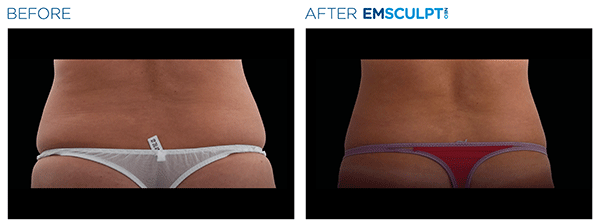 Emsculpt_Neo_PIC_Ba-card-female-lateral-abdomen-104_ENUS100