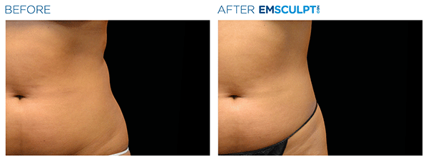 Emsculpt_Neo_PIC_Ba-card-female-lateral-abdomen-127_ENUS100