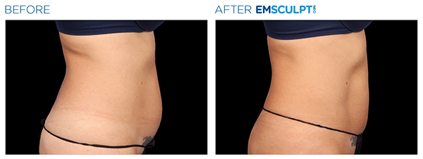 Emsculpt_Neo_PIC_Ba-card-female-lateral-abdomen-142_ENUS100