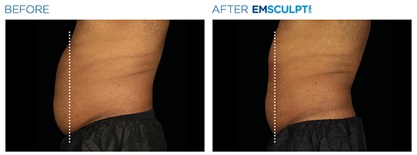 Emsculpt_Neo_PIC_Ba-card-male-lateral-abdomen-148_ENUS100