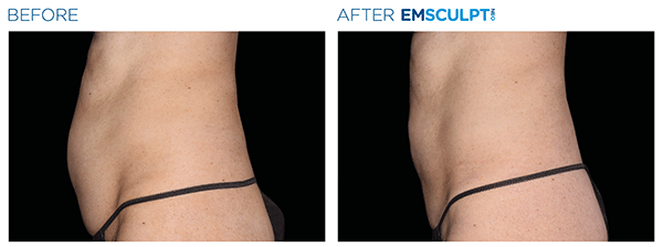Emsculpt_neo before and after