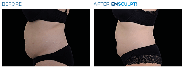 Emsculpt_neo_PIC_Ba-card-female-abdomen-020_ENUS100