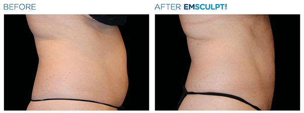 Emsculpt_neo_PIC_Ba-card-female-abdomen-040_ENUS100