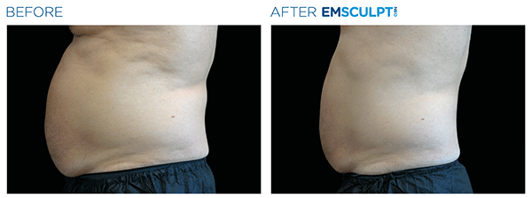 Emsculpt_neo_PIC_Ba-card-male-abdomen-002_ENUS100