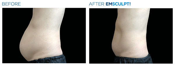 Emsculpt_neo_PIC_Ba-card-male-abdomen-022_ENUS100