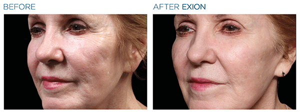 Exion_PIC_Ba-card-cheek-female-004_FRF_ENUS100