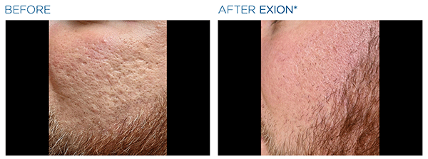 Exion_PIC_Ba-card-cheeks-male-010_FRF_ENUS100