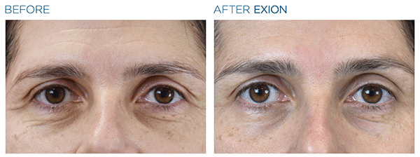 Exion_PIC_Ba-card-eyes-female-039_Face_ENUS100