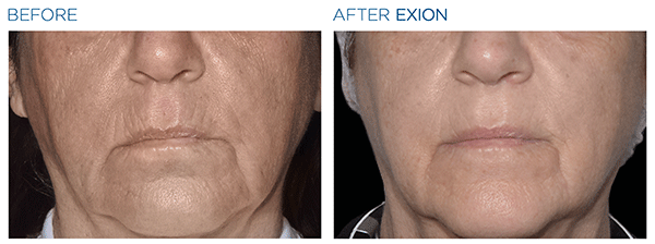 Exion_PIC_Ba-card-mouth-female-060_Face_ENUS100