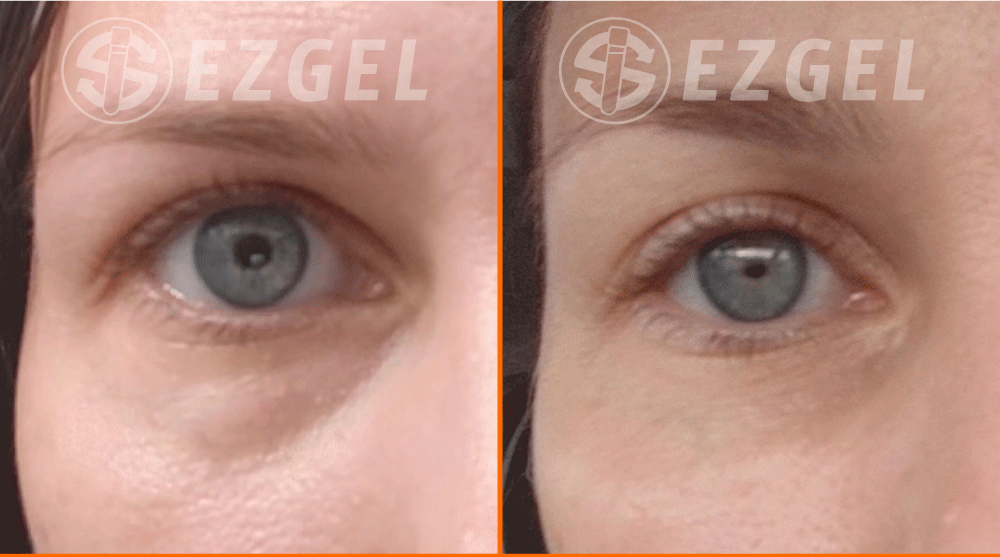ezgel-7